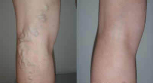 青筋告訴你所不知道的祕密！讓你看清楚身體哪裡出問題。