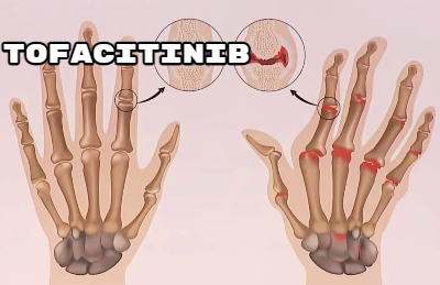 類風濕性關節炎的症狀是什麽