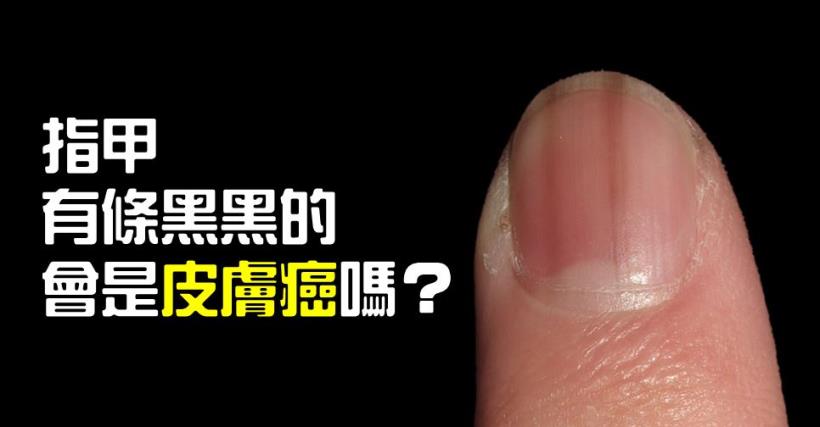 小心！指甲有黑色條紋，可能是得「皮膚癌」！