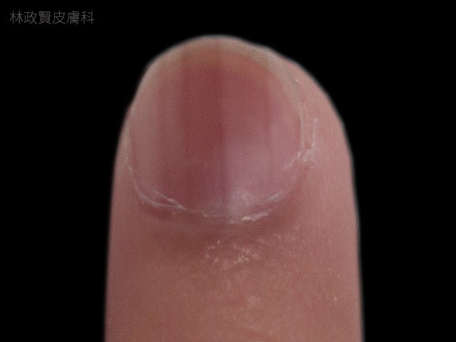 小心！指甲有黑色條紋，可能是得「皮膚癌」！