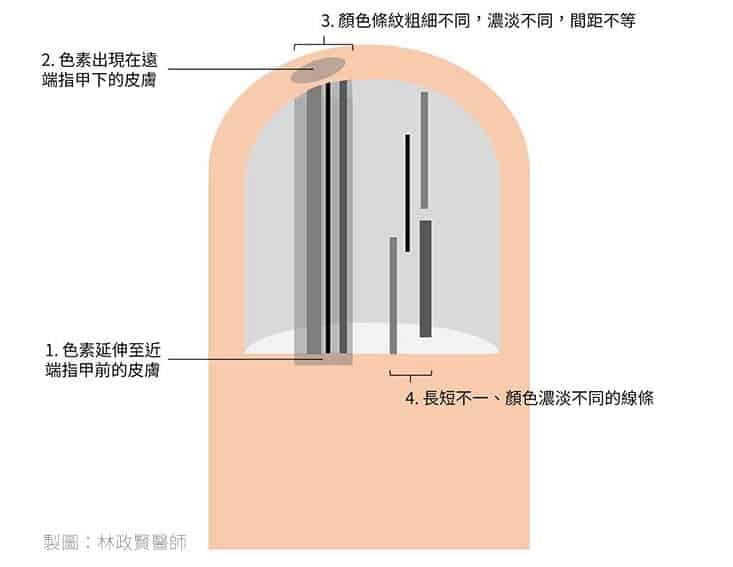 小心！指甲有黑色條紋，可能是得「皮膚癌」！