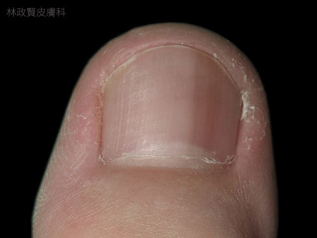 小心！指甲有黑色條紋，可能是得「皮膚癌」！