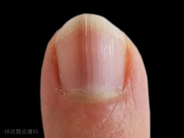 小心！指甲有黑色條紋，可能是得「皮膚癌」！