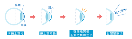 眼球商機:隱形眼鏡商機解析