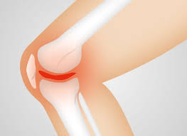 膝關節有積液嚴重嗎?到中環健康早期體檢能預防病變!