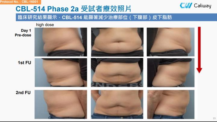 【產業戰隊VIP】消脂、竇根氏症進度雙衝！醫美公司最新法說會訊息更新
