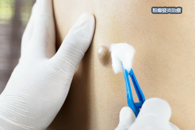 “粉瘤”是啥?如何處理?怎么預防?