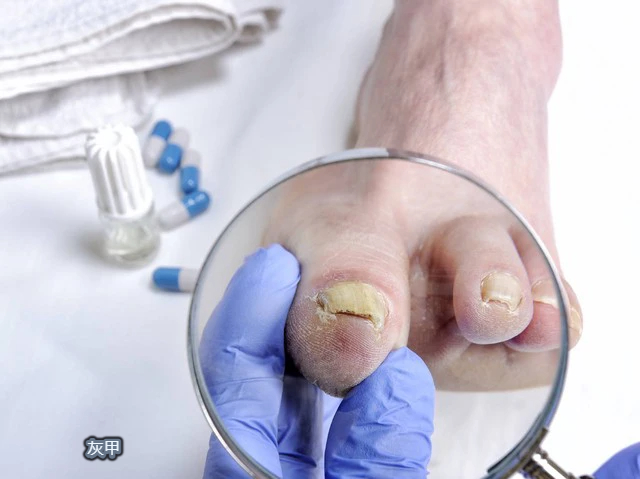 甲溝炎，灰指甲和足蘚都有哪些症狀，該如何治療?