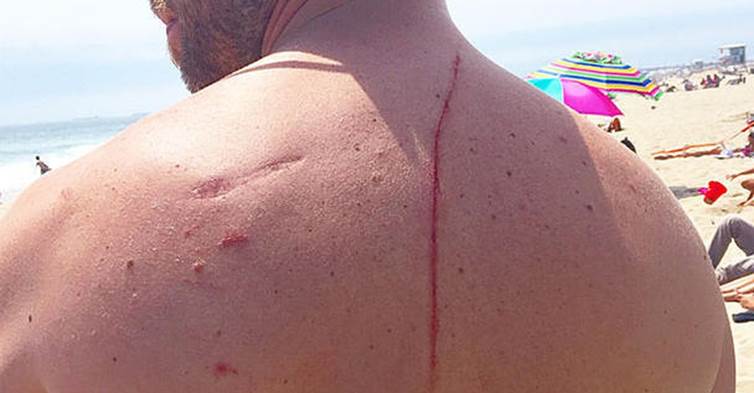 Finney被海中的生物襲擊，疼痛讓他徹夜難眠..但在看完醫生後，他卻反過來向「牠」說謝謝！Why?