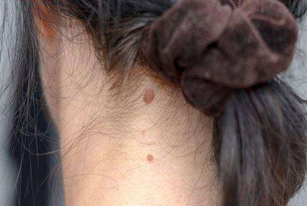 脖子長息肉 千萬要當心